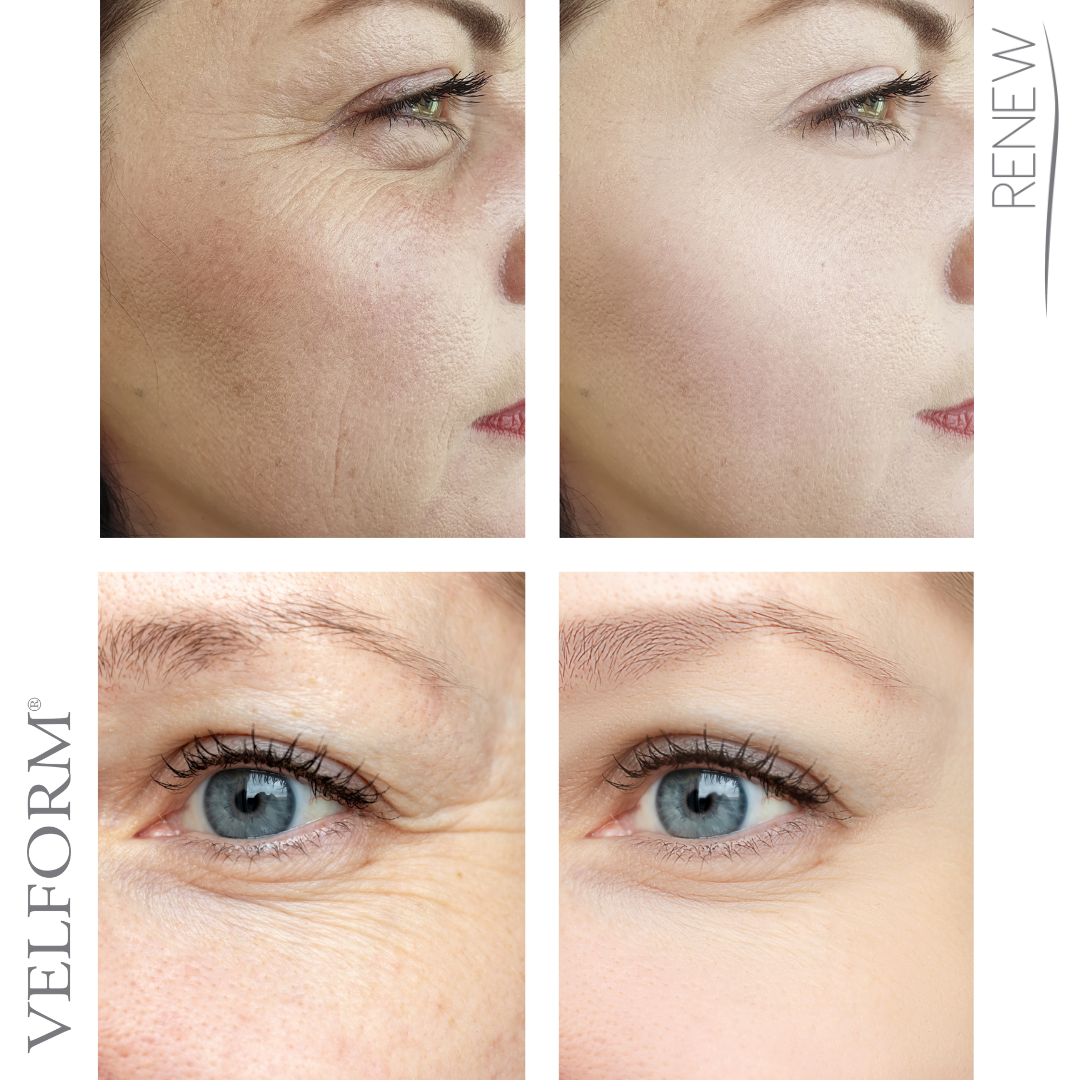 Parches solubles colágeno y ácido hialurónico para el rostro